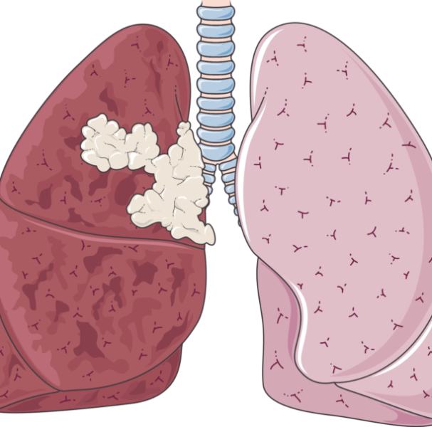 Cancer_poumons-680×605 Cancer_poumons-680x605